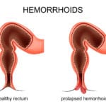 Cómo funcionan las hemorroides