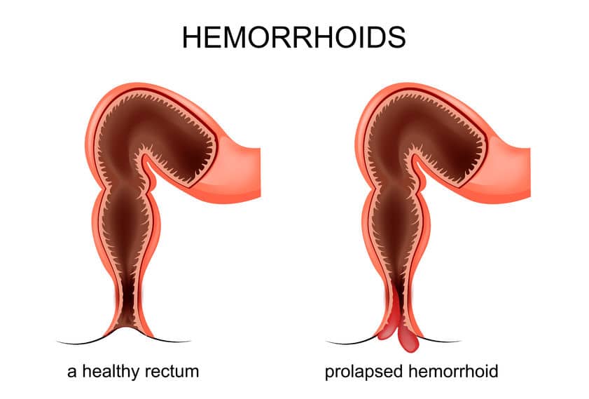 Hemorroides internas y externas