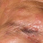 Herpes zóster en la zona ocular