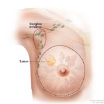 Inflamación de los ganglios linfáticos asociados al cáncer de mama