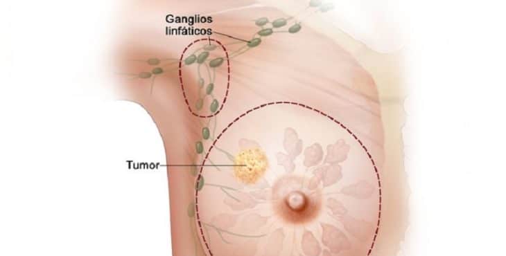 Metástasis de cáncer de mama