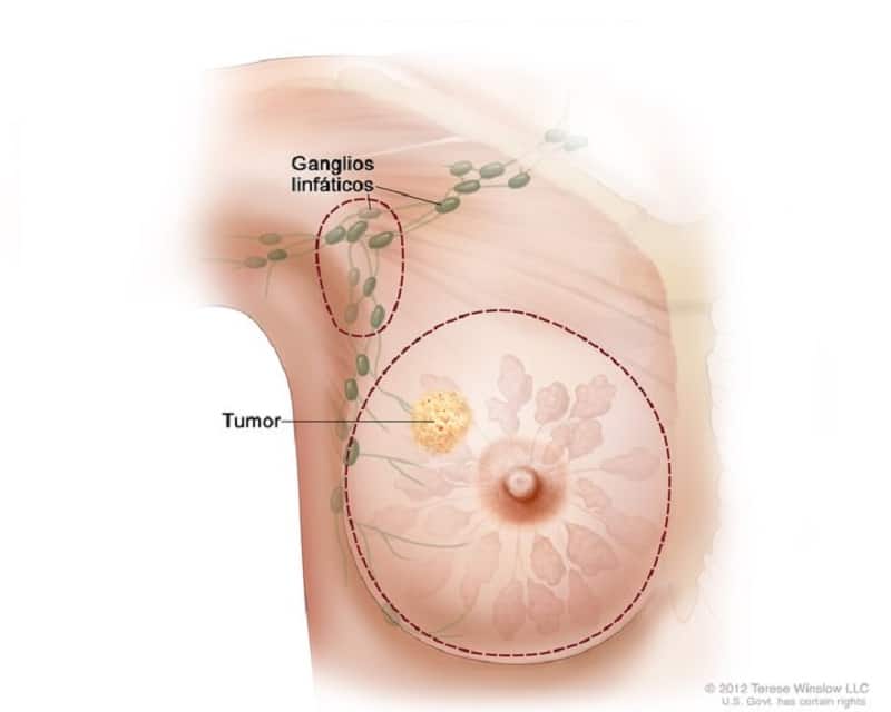 Metástasis de cáncer de mama