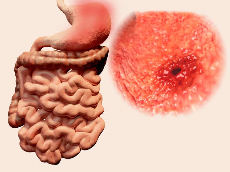 Cómo prevenir una úlcera estomacal