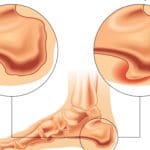 El espolón calcáneo es una de las causas del dolor de talón
