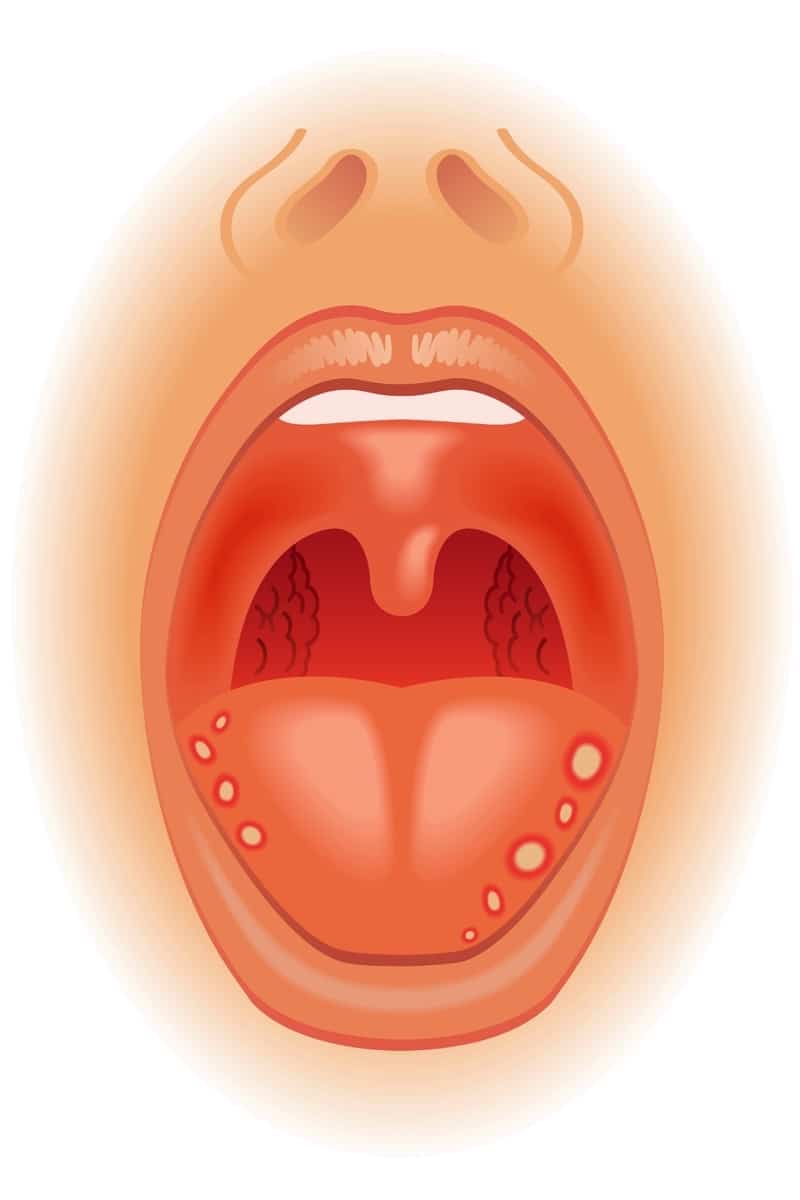 Las llagas en la lengua pueden ser únicas o en racimos