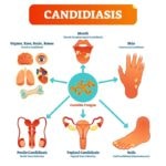 La candidiasis es una infección micótica que puede estar localizada en diferentes órganos