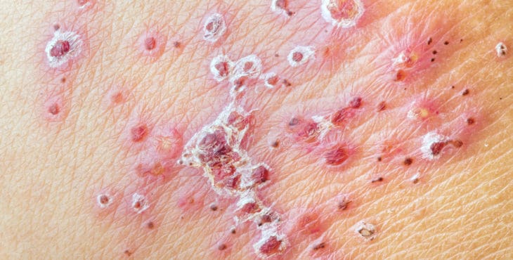 Claves para saber cómo reconocer el herpes