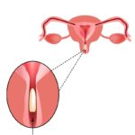 Supositorios vaginales