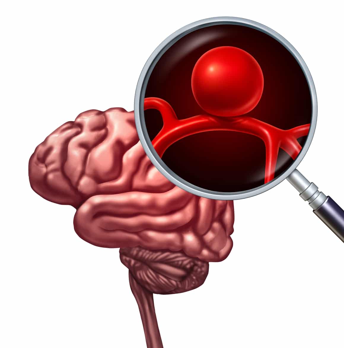 ¿Se puede conocer si tienes un aneurisma cerebral?