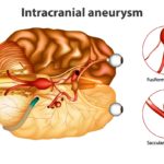 4-Tipos de aneurisma cerebral