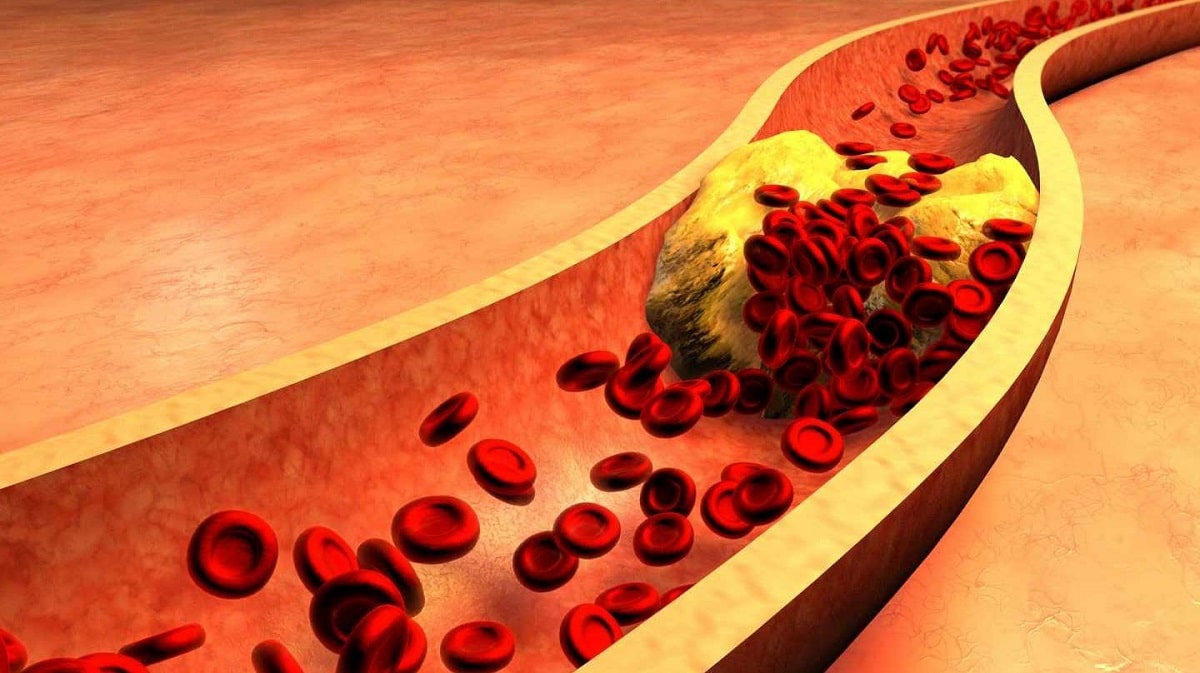 Vacuna contra el colesterol… ¿podremos olvidarnos de no comer grasas?
