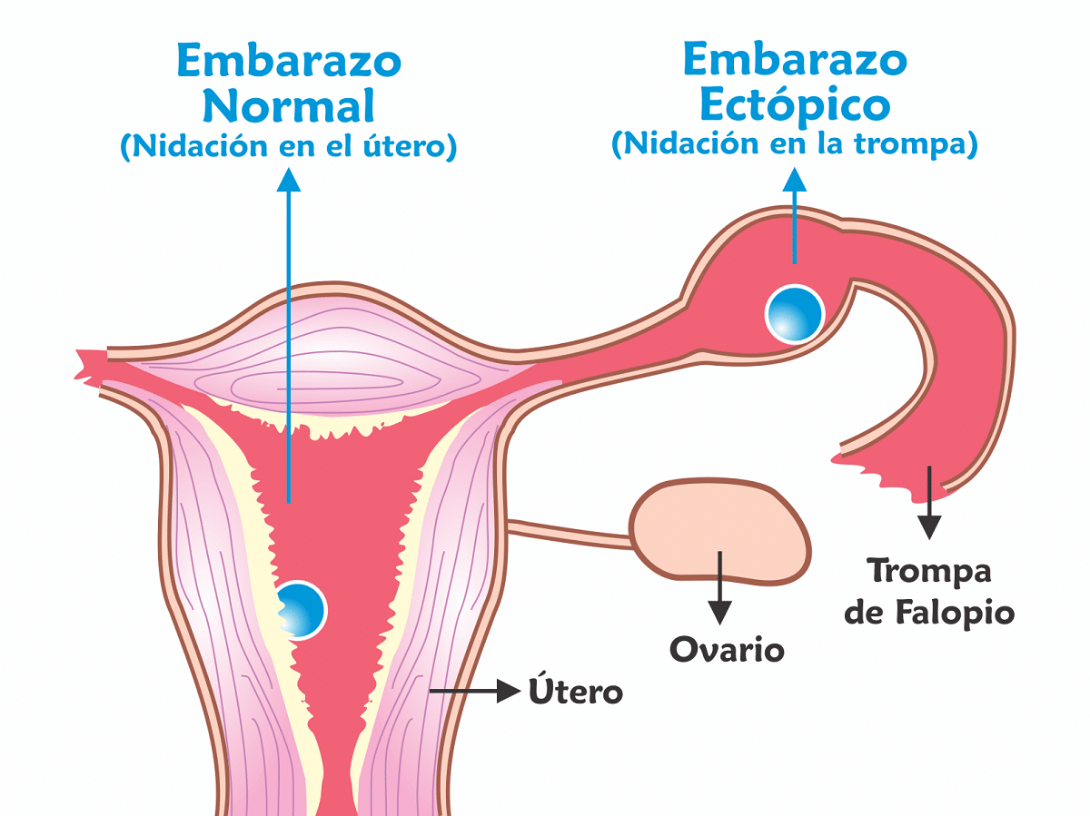 Despues de un embarazo ectopico se puede embarazar