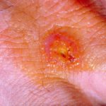 3- Lesión típica de la tularemia
