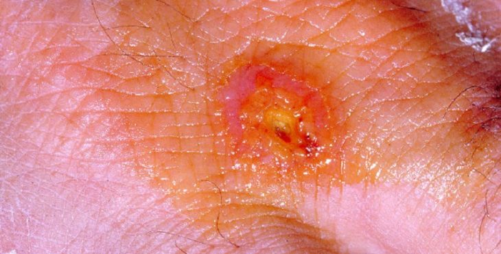 Lesión ulcerosa producida por Francisella tularensis