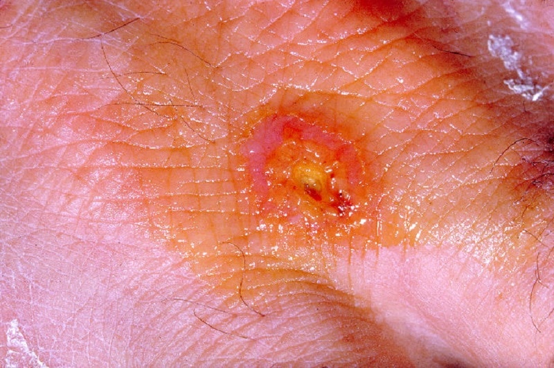 Lesión ulcerosa producida por Francisella tularensis