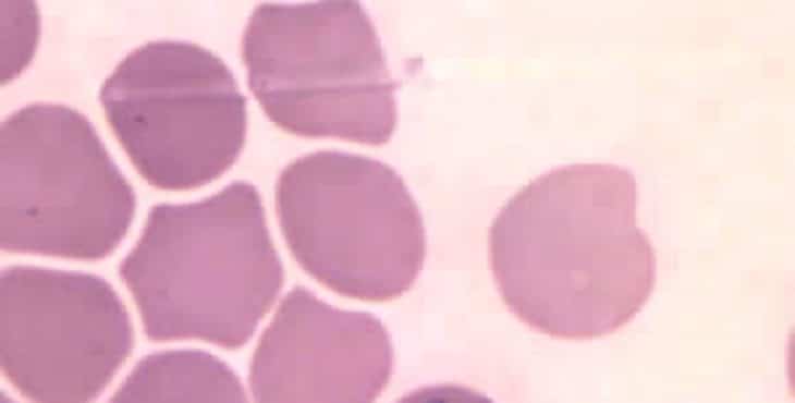 Glóbulos rojos afectados por babesia