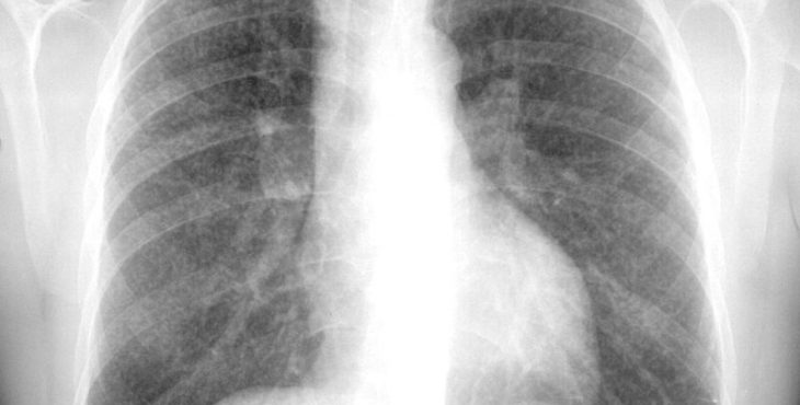 Rayos X de enfermo con silicosis