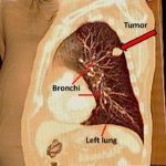 3-Los síntomas de cáncer de pulmón