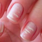 Manchas blancas en las uñas 4